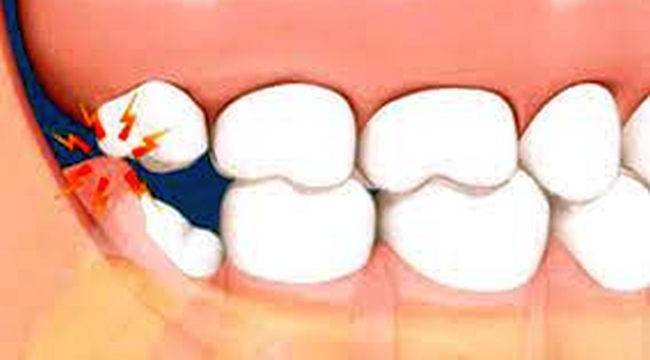 Yirmi Yaş Dişleri Nedir?