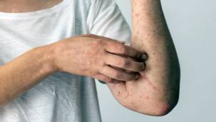 "ACI BAKLA, GİZLİ BİR ALERJENE DÖNÜŞTÜ"