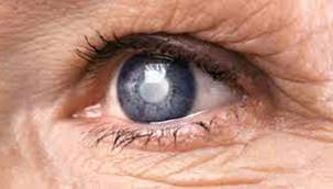 Katarakt Ameliyatı Bunama Riskini Azaltabilir...